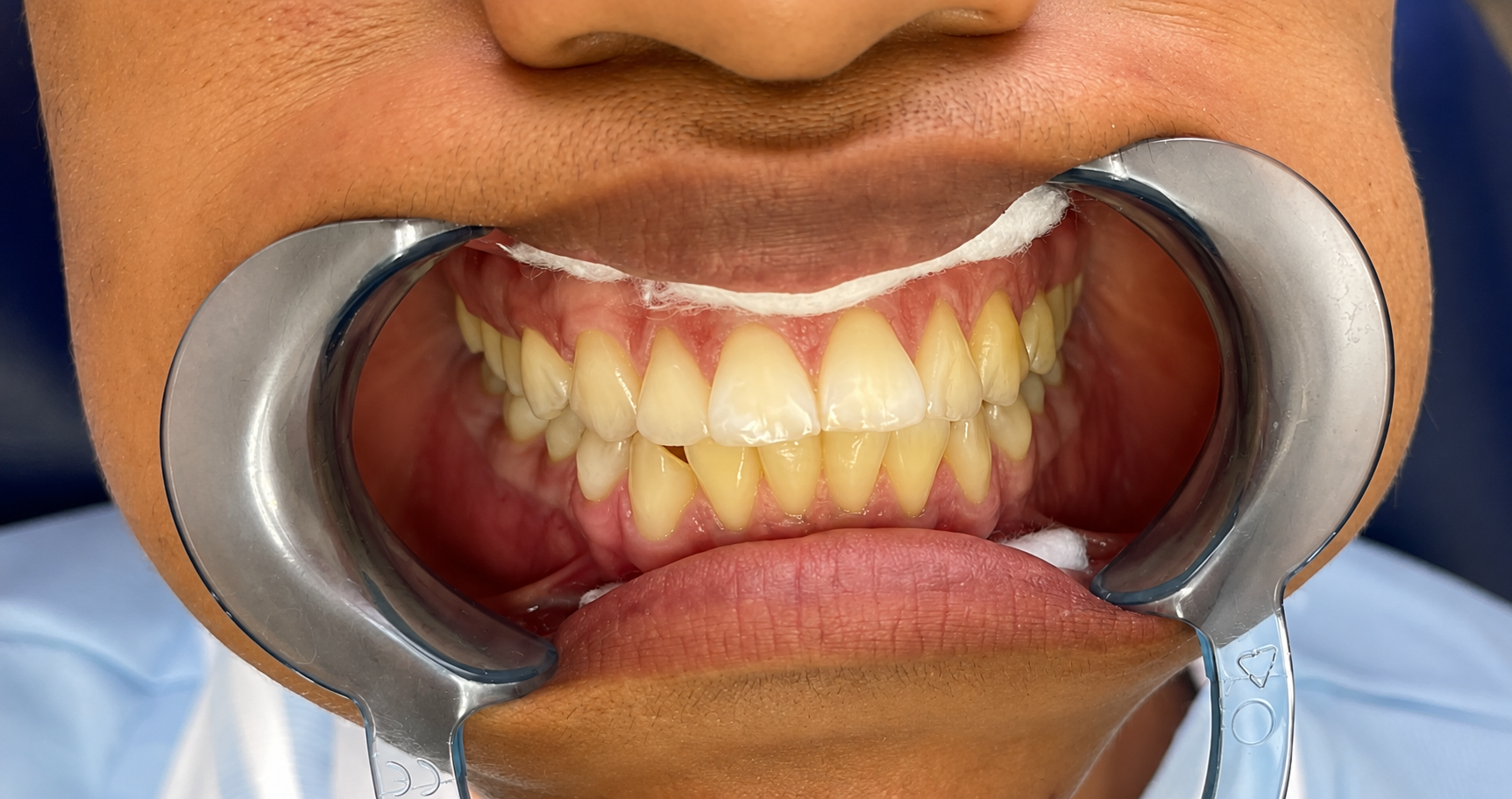 Brackets - Antes