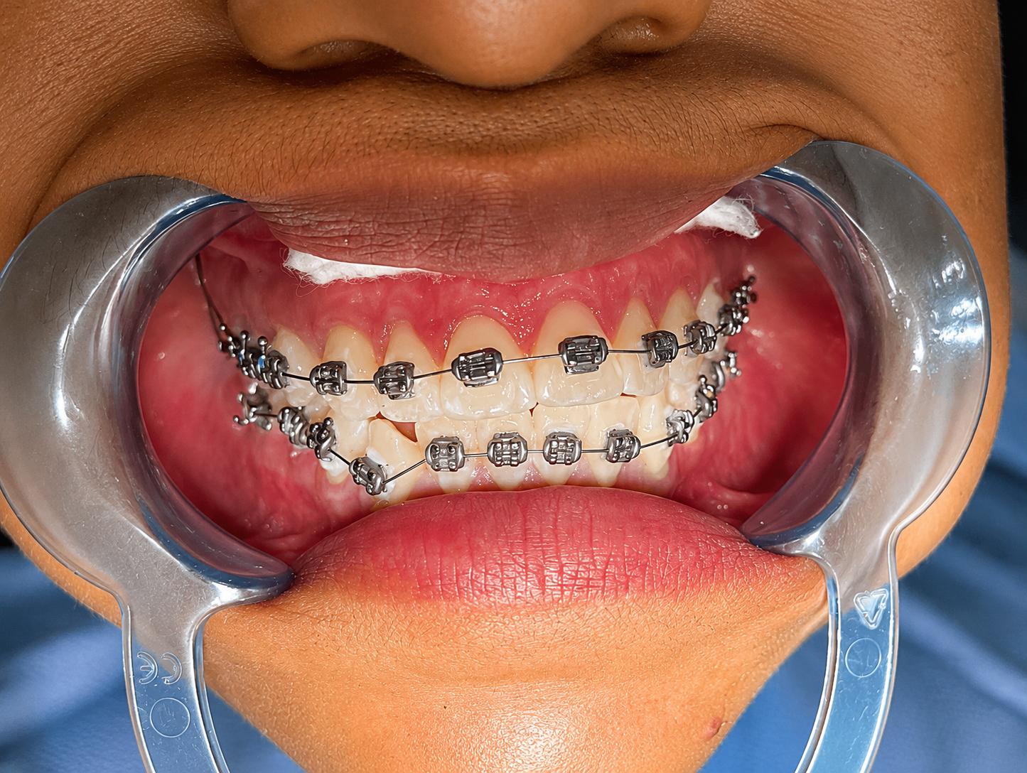 Brackets - Durante